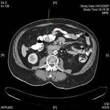 Carcinoid Tumor Radiology Reference Article Radiopaedia Org Radiology Tumor Carcinoid Syndrome