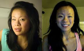 Facial Swelling Reduce Jaw Surgery Recovery Jaw Surgery Facial Surgery Surgery