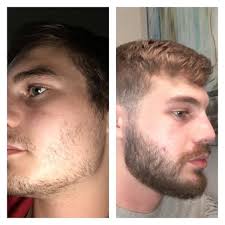 Since hair growth is a slow process, it may take some time before you see new hair growth after starting the. Minoxidil Guide For Thicker Beard Facial Hair And Fuller Eyebrows