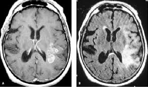 Primary Brain Tumors In Adults American Family Physician