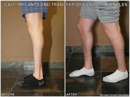 Http Drturowski Com Calf Augmentation Before And After Pictures
