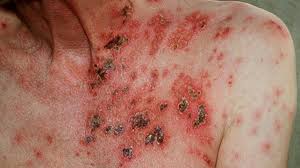 Shingles Symptoms With Pictures Also known as dimensional shingles, architectural roofing shingles are high quality. shingles symptoms with pictures