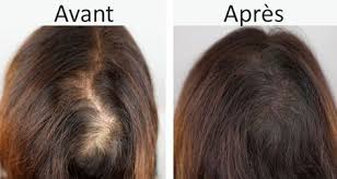 Un Masque Naturel Pour Ne Plus Perdre Vos Cheveux Chute De Cheveux Anti Chute Cheveux Perte De Cheveux