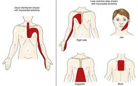 Pin On Upper Back Pain