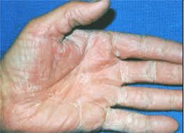 Does hand sanitizer kill the ebola virus? Ringworm Dermatologist In Sandy Springs Ga Roswell Ga Alpharetta Ga Cumming Ga