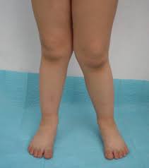 Knock Knees In Children Are Usually Not Treated If The Problem Is Still Present After Age 7 The Child May Use Bow Legged Correction Knock Knees Bow Legged