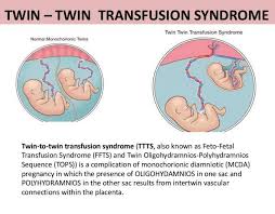 What Is Ttts Twin To Twin Transfusion Syndrome Twinstuff Syndrome Patient Education Obstetrics