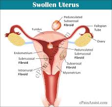 Swollen Uterus Or Enlarged Uterus Uterus Fibroids Uterine Fibroids