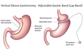 Pin On Bariatric Surgery