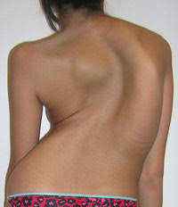 Marida S Story Scoliosis Scoliosis Research Society Scoliosis, a condition where the spine curves by 10 degrees or more, can cause back pain and discomfort and compromise mobility. marida s story scoliosis scoliosis