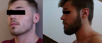 Minoxidil should not be used 24 hours before and after the hair treatment procedure. Minoxidil Beard Growth Journey Before And After 2018 Beard Bro