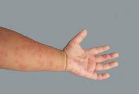 People With Low Immunity Level Should Be On Alert Against Chickenpox Universitas Gadjah Mada