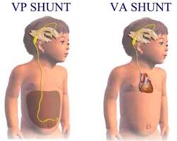 Shunts And Shunt Malfunction Neonatal Nurse Child Life Specialist Pediatric Nursing