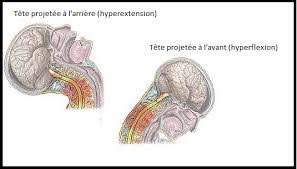 La localisation la plus courante des cervicalgies et des autres myalgies est la partie supérieure du muscle trapèze, mais il arrive aussi souvent que d'autres muscles. Cervicalgie Nevralgie Cervicale 6 Questions Frequentes Lors D Un Mal De Cou Clinique Chiropratique Sillery Chiro A Ste Foy Quebecclinique Chiropratique Sillery Chiro A Ste Foy Quebec