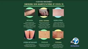 Coronavirus Symptoms Dermatology Organization Issues Guidance On Skin Rashes Associated With Coronavirus Abc7 San Francisco