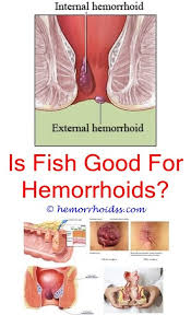 Pin On Hemorrhoid Surgery