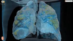 Hypoxia Covid 19 Some Coronavirus Patients Are Unknowingly Losing Oxygen At Dangerous Levels Experiencing Silent Hypoxia Abc7 Los Angeles