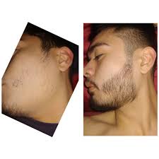 Another report on women using minoxidil also resulted in subjects experiencing severe hypertrichosis (excessive hair growth) on the face and limbs after using 5. 3 Months On Minoxidil I Will Hopefully Be Able To Achieve The Rare Asian Beard Soon Asian Beard Minoxidil Beard Beard