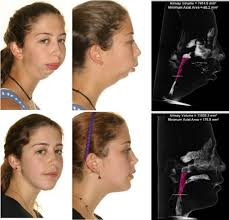 Photos Show Remarkable Transformation Of Girl With Jaw Deformity Jaw Surgery Surgery Orthognathic Surgery