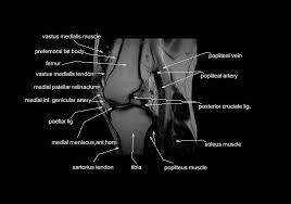 It bears this name because it consists of four individual muscles. Mri Knee Anatomy Knee Sagittal Anatomy Free Cross Sectional Anatomy