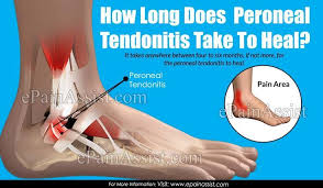 How Long Does Peroneal Tendonitis Take To Heal Peroneal Tendonitis Tendinitis Ankle Tendonitis