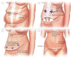 Pin On Tummy Tuck