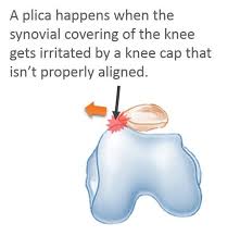 Knee Plica Surgery Recovery Knee Surgery Recovery Surgery Recovery Surgery