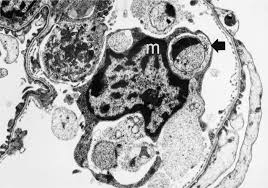 Electron energy loss spectroscopy (eels). Apoptosis In Post Streptococcal Glomerulonephritis Kidney International