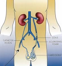 Pin On Varicoceles