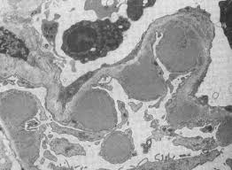 Examine things really, really close up. Immune Mediated Diseases Involving Basement Membranes Sciencedirect
