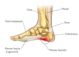 Top 5 Facts For Veterans With A Flat Feet Va Disability Claim Va Claims Insider