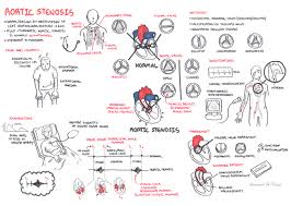 Aortic Stenosis Armando Hasudungan