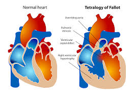 Tetralogy Of Fallot Wikipedia