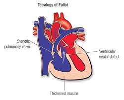 Tetralogy Of Fallot American Heart Association