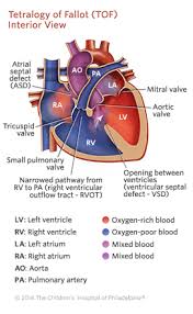 Tetralogy Of Fallot Tof Children S Hospital Of Philadelphia