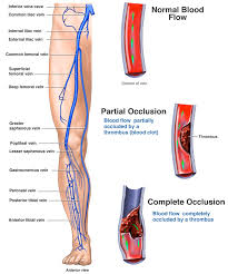 Deep Vein Thrombosis Symptoms And Treatment