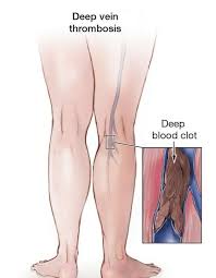 Deep Vein Thrombosis Treatment Nyc Surgical Associates