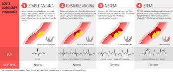 Nstemi is a type of heart attack. Acute Coronary Syndrome Acs Definitions Stable Grepmed