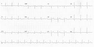 Ua/nstemi can sometimes be missed. Myocardial Ischaemia Litfl Ecg Library Diagnosis