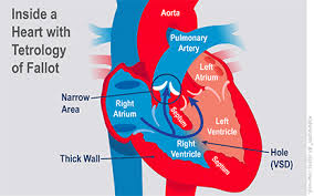 Tetralogy Of Fallot Tof For Parents Nemours Kidshealth