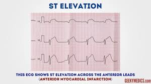 How To Read An Ecg Ecg Interpretation Ekg Geeky Medics