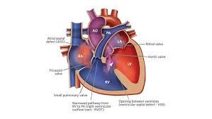 Tetralogy Of Fallot Tof Children S Hospital Of Philadelphia