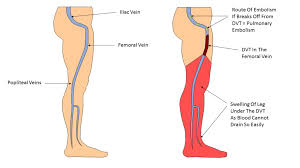 What You Need To Know About Dvt Dr Morton S The Medical Helpline