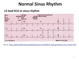 Acls Ce Part I Of Iii Ecg Strip Interpretation W Case Scenarios Sup
