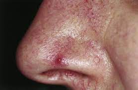 Cherry Angioma Symptoms Causes And Treatment