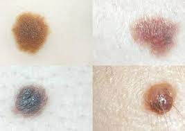 When To Worry About Moles On Your Child Different Types And Skin Cancer Risks Lifestyle News Asiaone