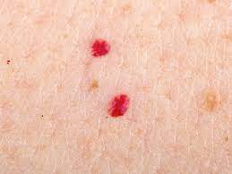 What Are Red Moles And Are They Dangerous First For Women
