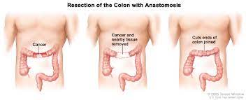 Colorectal Surgery Colon Cancer