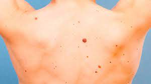 How To Tell If Moles Are Skin Cancer Teen Vogue