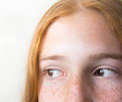 What Are Red Moles On The Skin The Yucatan Times